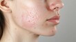 © Phatharaporn - Close-up of woman's face with acne.