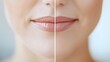 © Alpha - Time-lapse video of fine lines around the mouth fading after a series of anti-aging treatments, showing clear progression from deep wrinkles to smooth skin in before-and-after shots