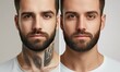 © Valentyna - Before and After Tattoo Removal. Man before and after laser tattoo removal procedures, closeup comparison collage.