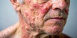 © DigitalArt Max - Psoriasis Awareness Portrait Photography Showcasing Erythematous Plaques, Medical Dermatitis, Skin Conditions, Health Education, Dermatology, and Patient Care