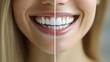 © Alpha - Before-and-after testimonial of a teeth whitening journey, focusing on the transformation from stained, yellowish teeth to a beautifully white, fresh smile