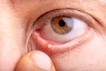 Ophthalmic hordeolum, close-up of an adult male eye with a stye (ophthalmic hordeolum), selective focus.