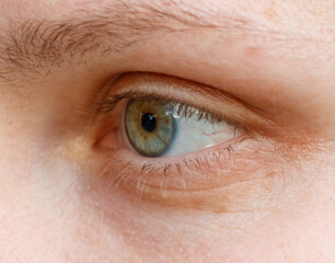 A close up of a person's eye with a greenish tint