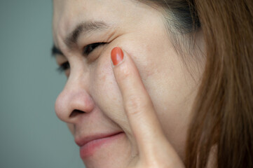 Cropped shot view of Asian woman pointing to crow's feet occur on the side of the eye.