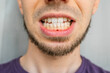 © Ivan - Close-up of a man's crooked teeth needing orthodontic treatment