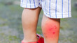 © Oporty786 - child with scraped knee stands on grassy surface, showcasing minor injury with redness and swelling. scene captures essence of childhood adventures and occasional mishap