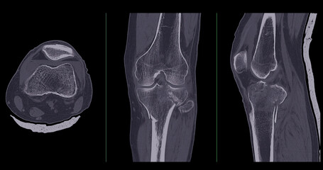 Poster - ct imaging of tibia and fibula fracture in trauma case .a detailed ct scan highlighting a traumatic 