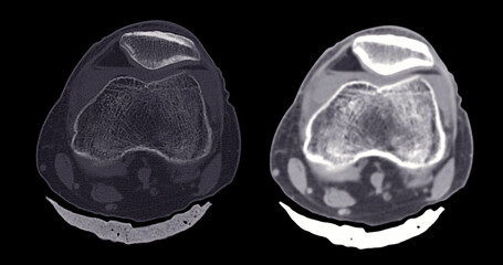 Poster - a clear ct scan image of a healthy, normal knee joint, showcasing the bone structure and joint align