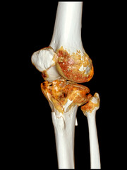 Poster - trauma case: tibia and fibula fracture in 3d ct scan.a detailed 3d medical scan showing traumatic fr