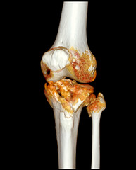 Poster - trauma case: tibia and fibula fracture in 3d ct scan.a detailed 3d medical scan showing traumatic fr
