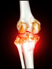 Poster - trauma case: tibia and fibula fracture in 3d ct scan.a detailed 3d medical scan showing traumatic fr
