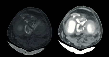 Poster - ct imaging of tibia and fibula fracture in trauma case .a detailed ct scan highlighting a traumatic 