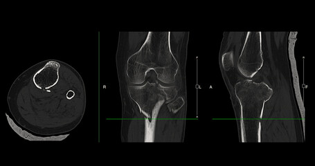 Poster - ct imaging of tibia and fibula fracture in trauma case .a detailed ct scan highlighting a traumatic 
