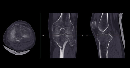 Poster - ct imaging of tibia and fibula fracture in trauma case .a detailed ct scan highlighting a traumatic 