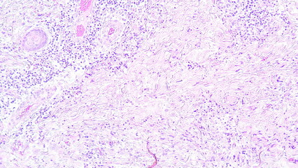 photomicrograph showing histology of a fibrolipoma, benign growth of fatty tissue, photo under micro
