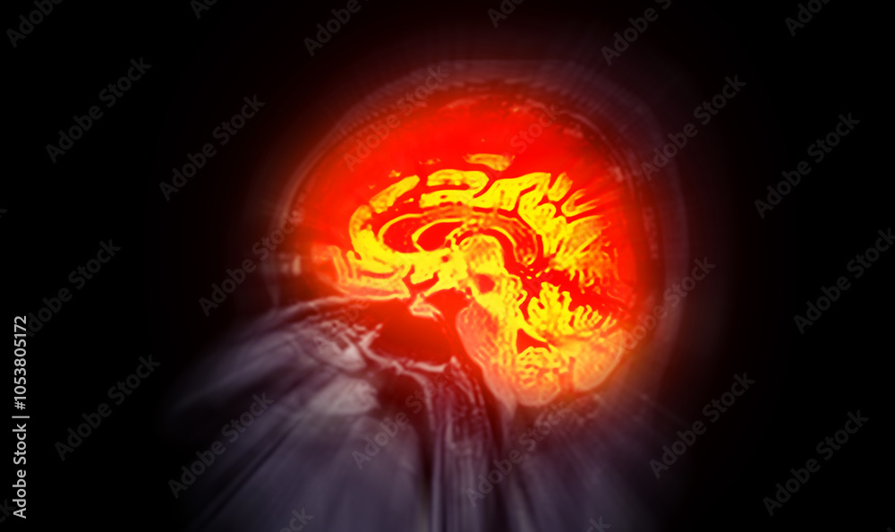 MRI scan of the brain with highlighted regions in red, potentially ...