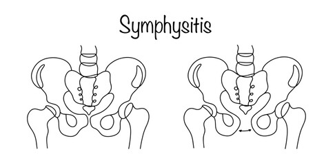 Wall Mural - Symphysitis