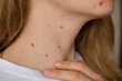 © anna.stasiia - Unrecognizable woman showing her Birthmarks on neck skin Close up detail of the bare skin Sun Exposure effect on skin, Health Effects of UV Radiation Woman with birthmarks Pigmentation