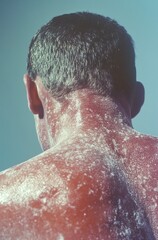 A person with sunburn on their back, a photograph of the skin discoloration caused by ultraviolet rays from sunlight. generative ai