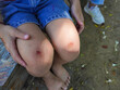 © scentrio - A young girl injured her knee while playing outdoors on a playground. Wounded knee of the child.