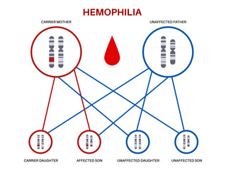 Hemophilia inheritance poster