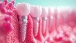 © B8stock - Dental implants in gum tissue model.