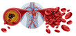 © freshidea - Atherosclerosis medical condition as Blocked Human Artery concept and restricted blood flow in arteries as a blood vessel disease with cholesterol fat buildup clogging or blocking circulation. © freshidea - Atherosclerosis medical condition as Blocked Human Artery concept and restricted blood flow in arteries as a blood vessel disease with cholesterol fat buildup clogging or blocking circulation.