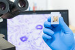 © arcyto - Scientist wear blue glove holding parafin human tissue block and out of focus microscope and computer monitor show glandular image.Medical patholology and cytology laboratory technology concept.