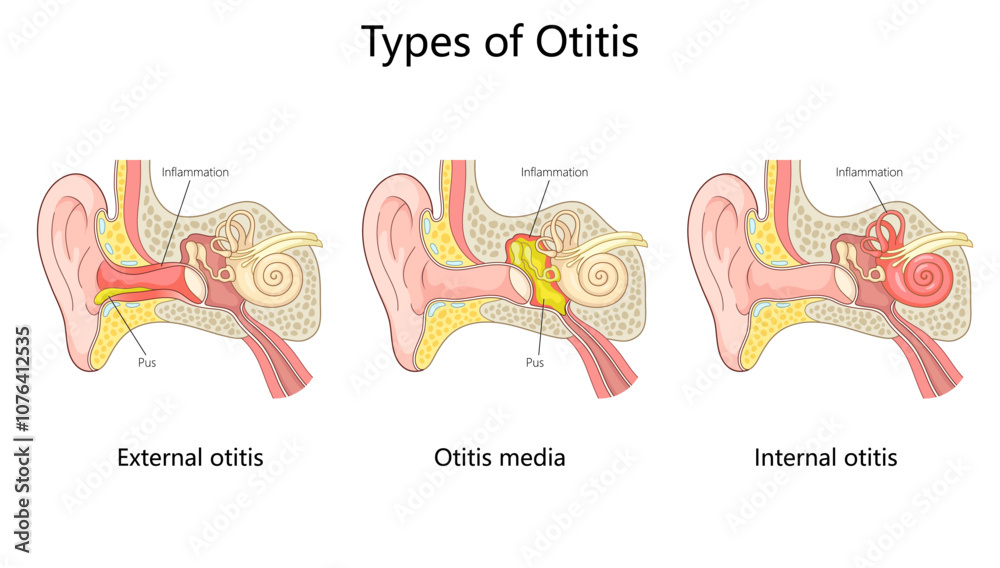 otitis ear infections external otitis, otitis media, and internal ...