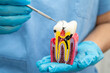 © kanruthai - Teeth root dental model with tool for dentist use to cleaning care treatment.