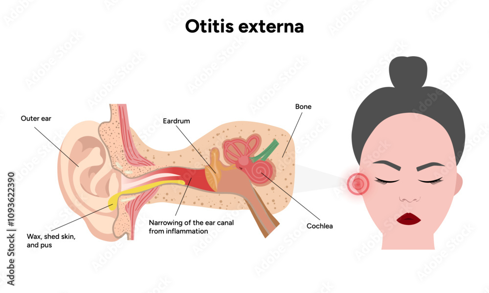 Otitis externa anatomy ear disease inflammation Stock Vector | Adobe Stock
