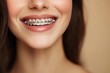 © Avve Diana  - An orthodontic brace-wearing woman smiles as she wears her braces