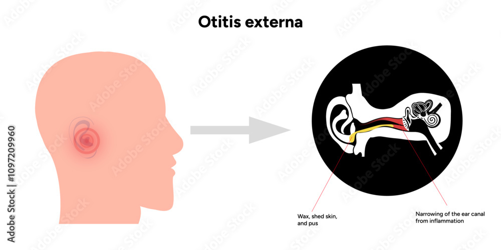 Otitis externa anatomy ear disease inflammation Stock Vector | Adobe Stock