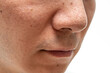 © Taro - いちご鼻のクローズアップ：30代男性の毛穴と角栓