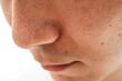 © Taro - いちご鼻のクローズアップ：30代男性の毛穴と角栓