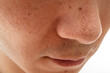 © Taro - いちご鼻のクローズアップ：30代男性の毛穴と角栓