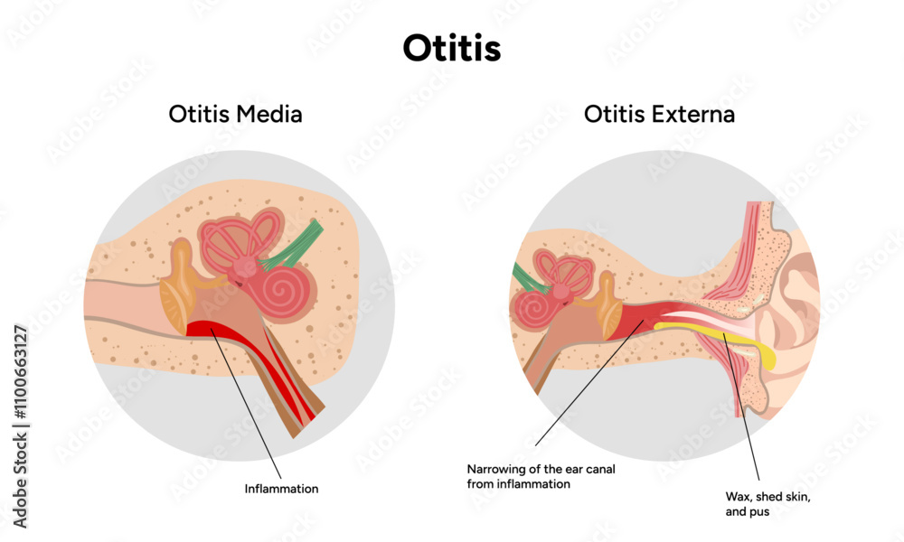 Otitis media and externa inflammation anatomy human ear pain disease ...