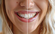© SakurraViki  - Before and After Teeth Whitening Comparison. Yellow vs. White Teeth Smile Transformation. Teeth Whitening Before and After Close-Up.