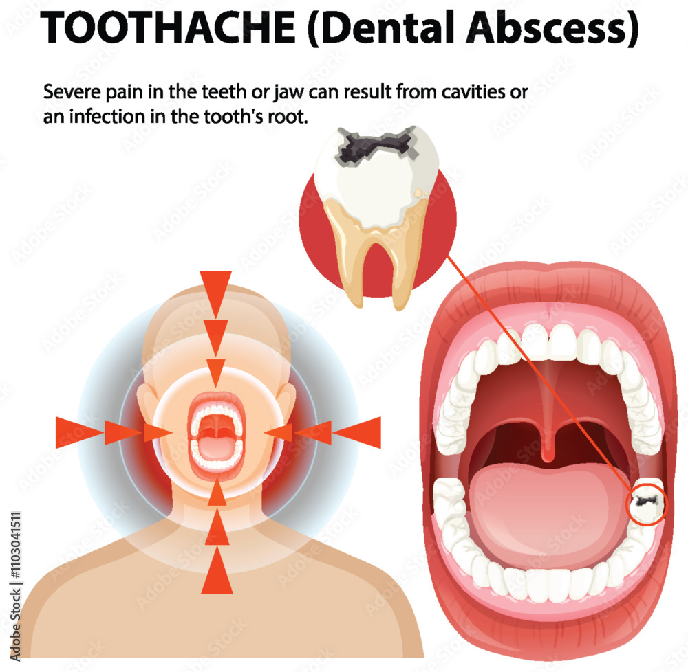 Understanding Dental Abscess and Toothache Stock Vector | Adobe Stock
