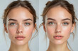 © Nyetock - Woman face before and after acne treatment procedure. Skin care concept