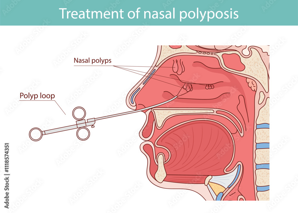 Nasal Polyps Diagram Anatomy Of The Nasal Cavity Sinuses Mouth Nasal Polyps Diagram Anatomy Of The Nasal Cavity Sinuses Mouth