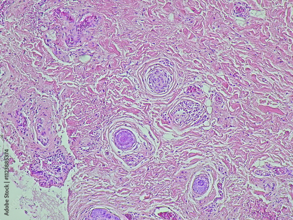 Lobulus Ear Photomicrograph showing histology of a atheroma cyst on the lobulus ...