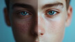 © Herseliia - White European Blonde Man, Treatment Dermatology, Cosmetology Beauty Procedures, Freckles, Acne, Before and After Banner