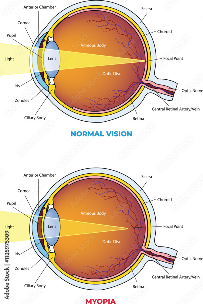 illustration of Myopia vs normal eye diagram Stock Vector | Adobe Stock