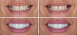© UniqDream - PrintSmile design treatment in dental aesthetic dentistry with laminate veneers and dental crown restorations using computer-aided design. Dental design treatment, before-and-after, and digital design