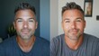 © bird_saranyoo - A man from the United States shares his journey through a cosmetic surgery transformation with before-and-after visuals