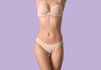 Wall Mural - Young woman in underwear with marks on her body against lilac background. Plastic surgery concept