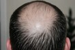 © ninakosh - Balding pattern on a man\'s head captured in a close-up shot indoors