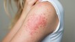 © Alex Pios - arm showing hives and redness as a result of an allergic reaction