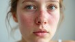 © Alex Pios - Woman  face showing signs of allergy symptoms, such as redness and swelling around the eyes and nose